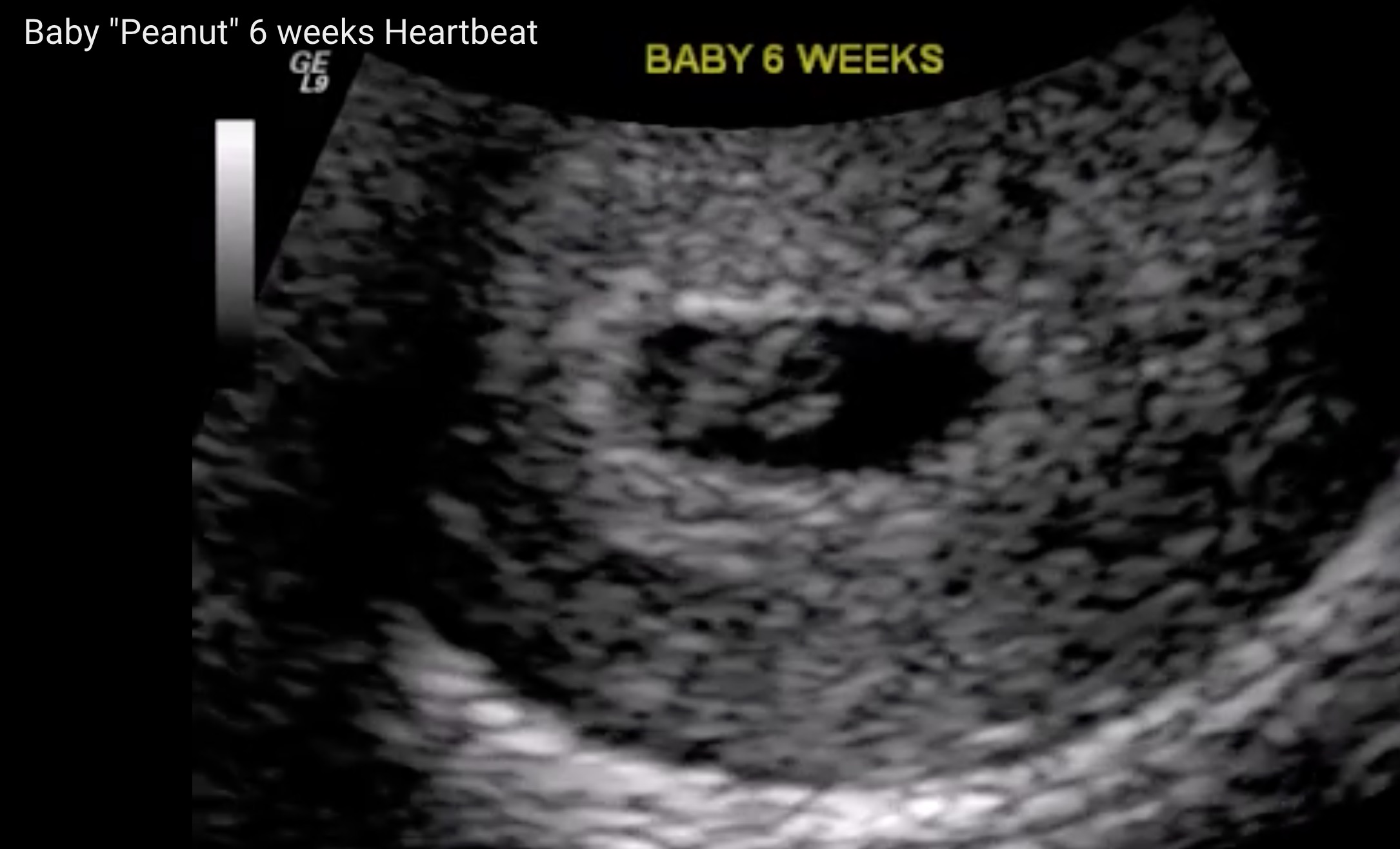 Georgia's 'Heartbeat bill' struck down by federal judge