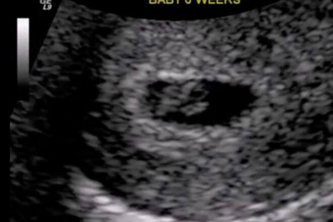 Georgia Defends Fetal Heartbeat Law