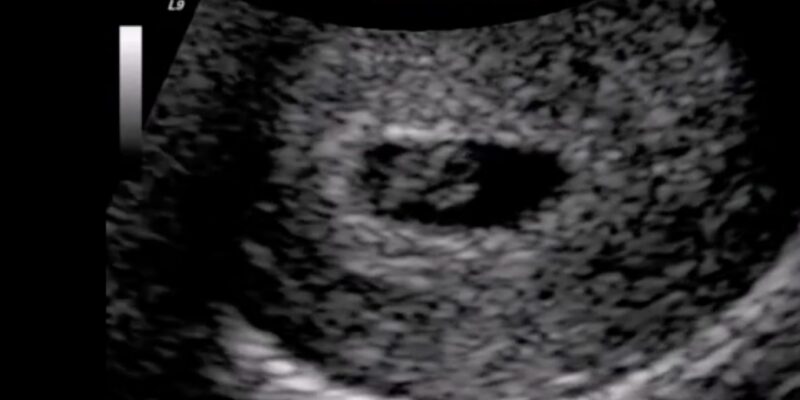 Georgia Defends Fetal Heartbeat Law